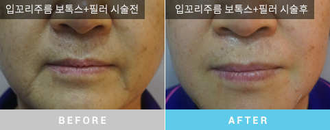 시술전후09